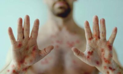 Mpox en Colombia: Bogotá y Cali Lideran Casos desde el Inicio del Brote en 2022